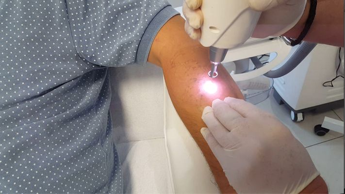 Laser Tattoo Removal Youtube Thumbnail